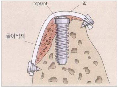 골이식임플란트사진