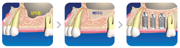 상악동거상술사진